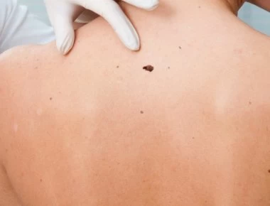 Τι σημαίνει αν έχετε μια ελιά που «σας τρώει» – Πότε η φαγούρα είναι καρκίνος του δέρματος